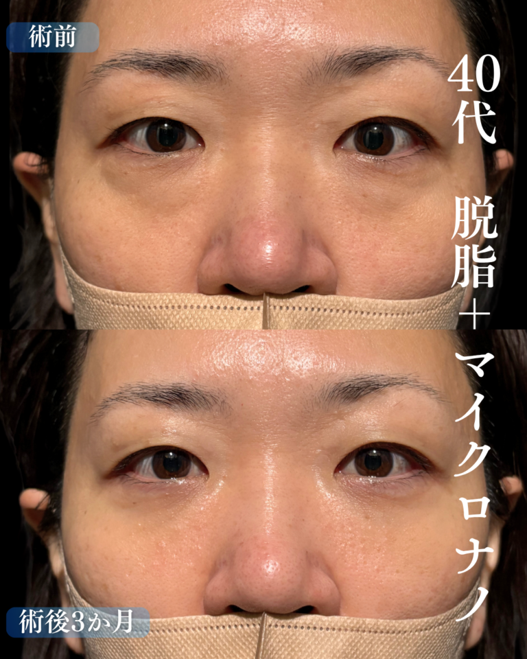 40代女性　脱脂+脂肪注入